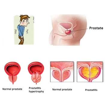 100 Ks Muž Zdravotní Péče Urologické Prostata Patch Prostatitis Léčba Čínské Bylinné Urologii Lék Na Prostatické Pupku Omítky
