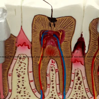 2020 Zubní Anatomie zubního kazu plastové zuby model ukázka komunikace