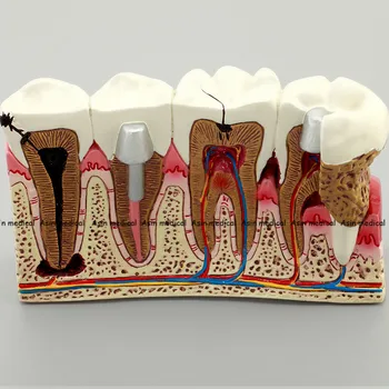 2020 Zubní Anatomie zubního kazu plastové zuby model ukázka komunikace