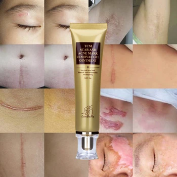 LANBENA Akné Odstranění rozšířených žilek Krém Skin Repair Krém na Obličej, Léčba Akné Pupínek Akné, Skvrny Bělící Krém na strie 30ml